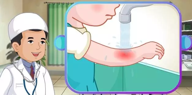 孩子燒傷,防患重于急救