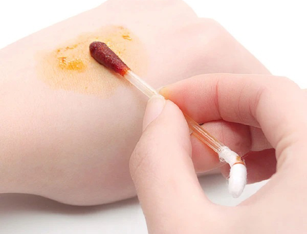 酒精消毒和碘伏消毒：分別適用在那些場景中使用，如何區(qū)別呢？